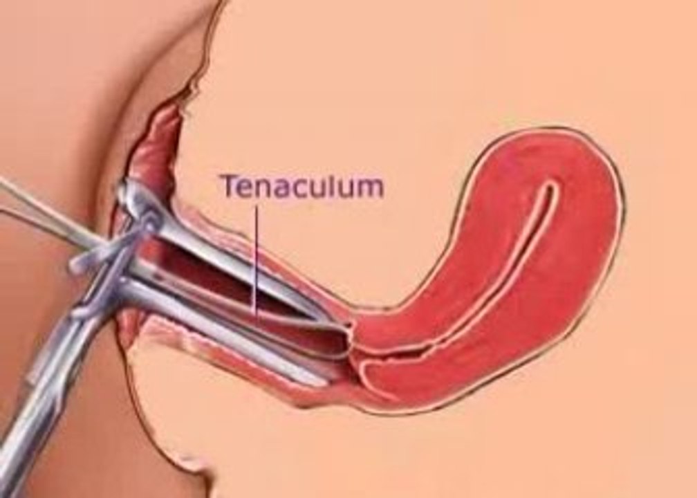 Endometrial Biopsy