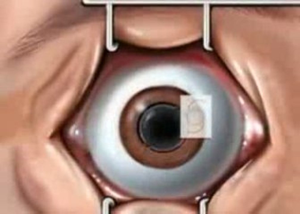Cataract surgery