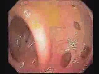 What Is The Best Treatment for Diverticulitis?