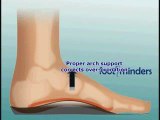 Foot Pain Due to Flat Feet and Over-Pronation