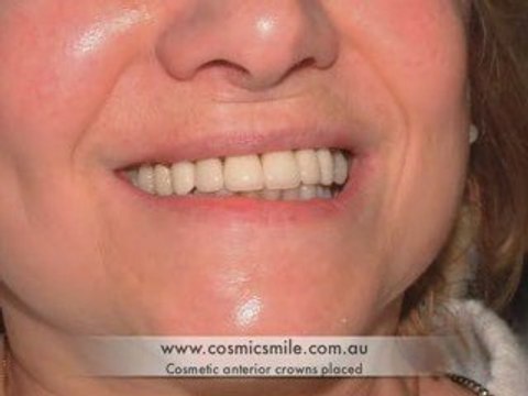 Cosmetic Dentist Sydney-Dental Crown Smile Makeover