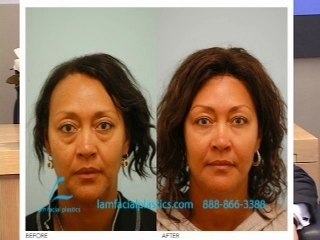 Cosmetic Surgery Dallas: Fillers vs. Lifts – Which Is Right for You? 💉