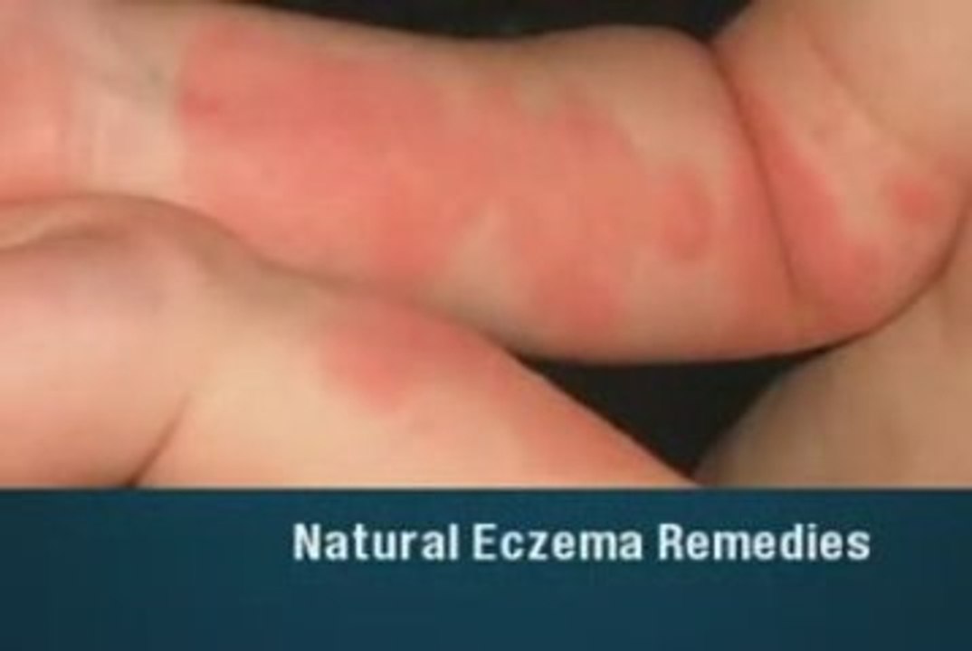 Natural Eczema Remedies