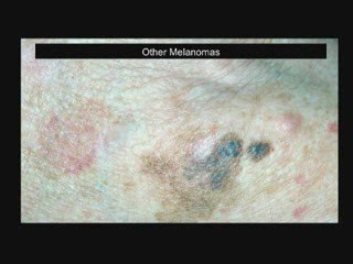 May is Skin Cancer Awareness Month