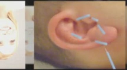 Cure Ringing Ears In Only a Few Steps