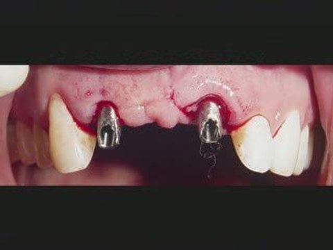 DENTAL IMPLANT JALANDHAR ,PUNJAB,INDIA CHANDIGARH LUDHIANA