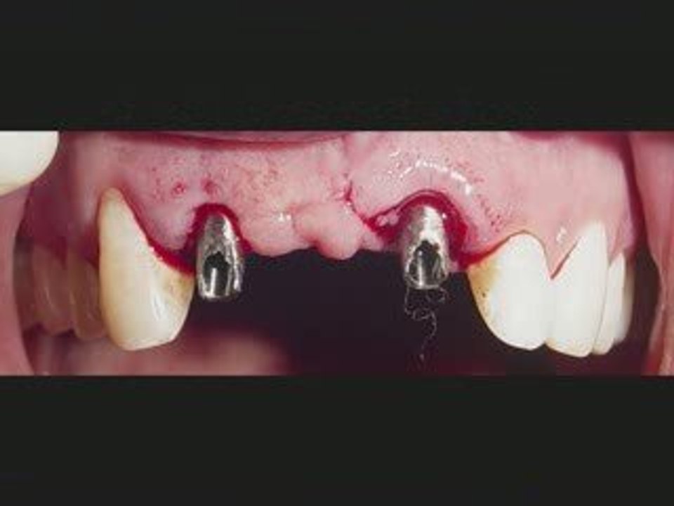 DENTAL IMPLANT JALANDHAR ,PUNJAB,INDIA CHANDIGARH LUDHIANA