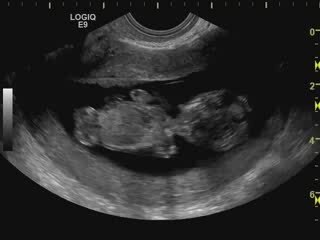 bébé se retourne echo 12 SA