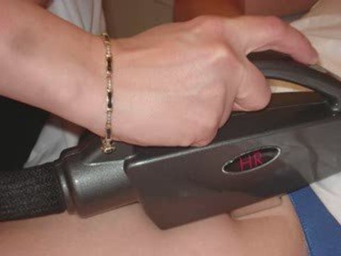 laser Hair Removal Bikini Line