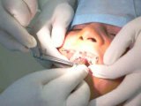 Dental Clinic In Jalandhar For Dental Implants