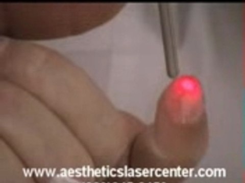 Laser Skin Treatments Tawas Michigan