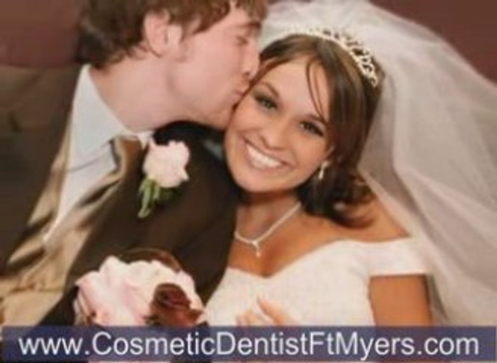 Veneers Ft Myers, Veneers Naples, Veneers Cape Coral