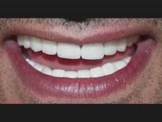 Jalandhar Dental Teeth Whitening Ludhiana punjab india