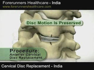 Low price artificial disc replacement surgery in India