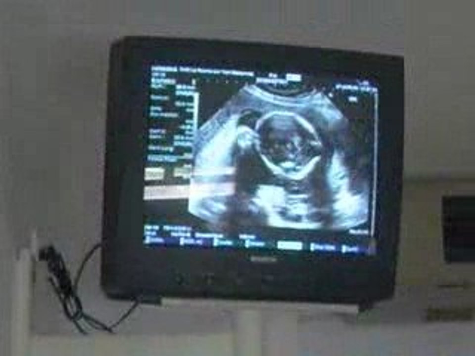 2eme echographie
