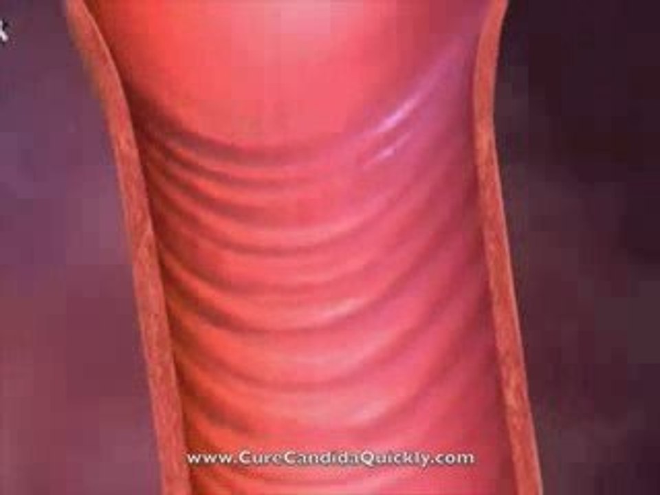 Cure Candida Yeast Infections