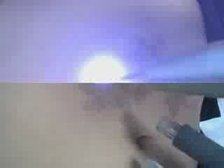 Tattoo Removal - Vines on Stomach