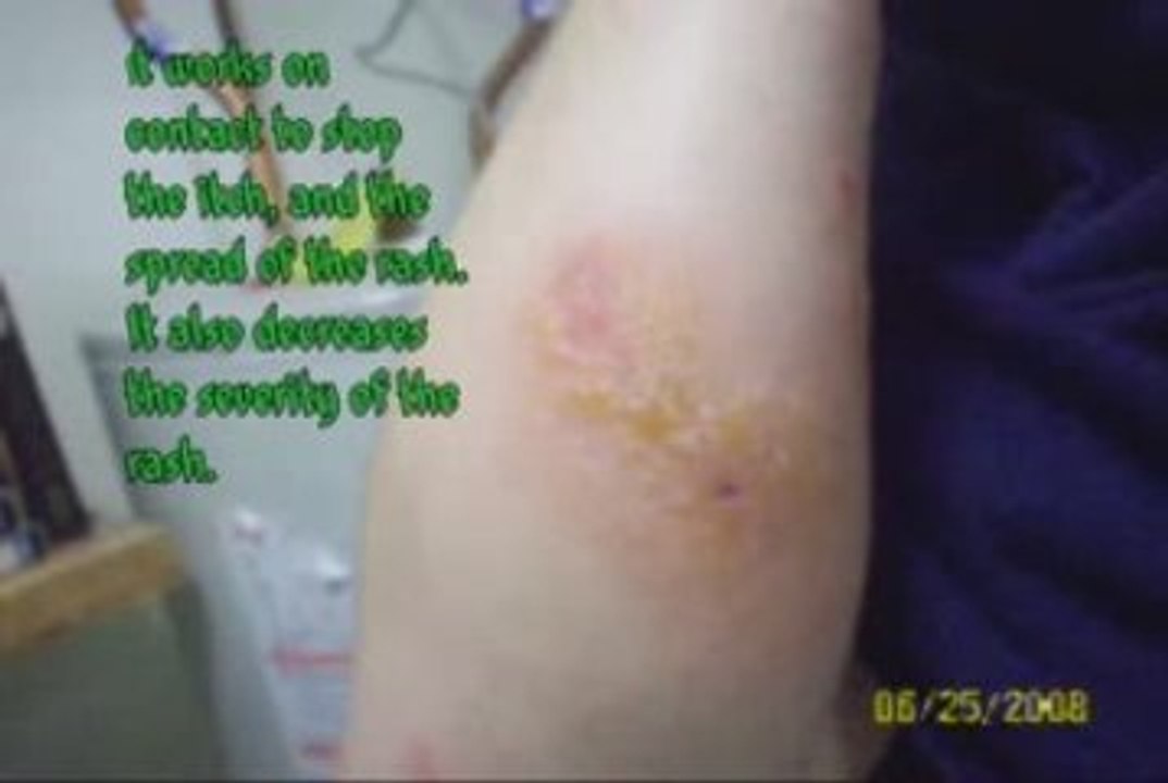 The affects of Poison Ivy and how All Stop works.