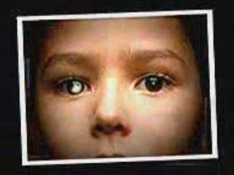 Retinoblastoma