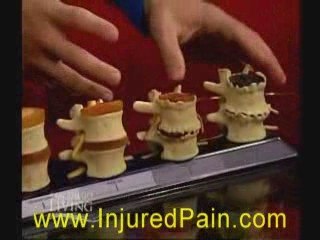 Chula Vista chiropractors for back pain