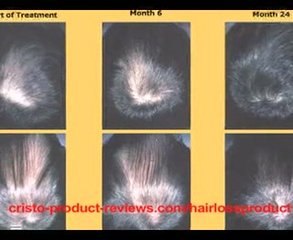 How to stop DHT from causing Male Hair Loss