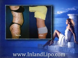 Temecula Liposuction - Liposuction Temecula