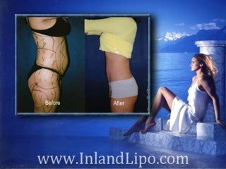 Riverside Liposuction - Liposuction Riverside