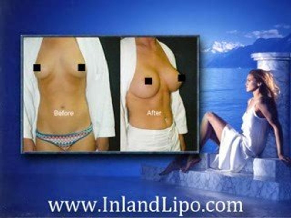 Murrieta Breast Augmentation - Breast Implants Murrieta