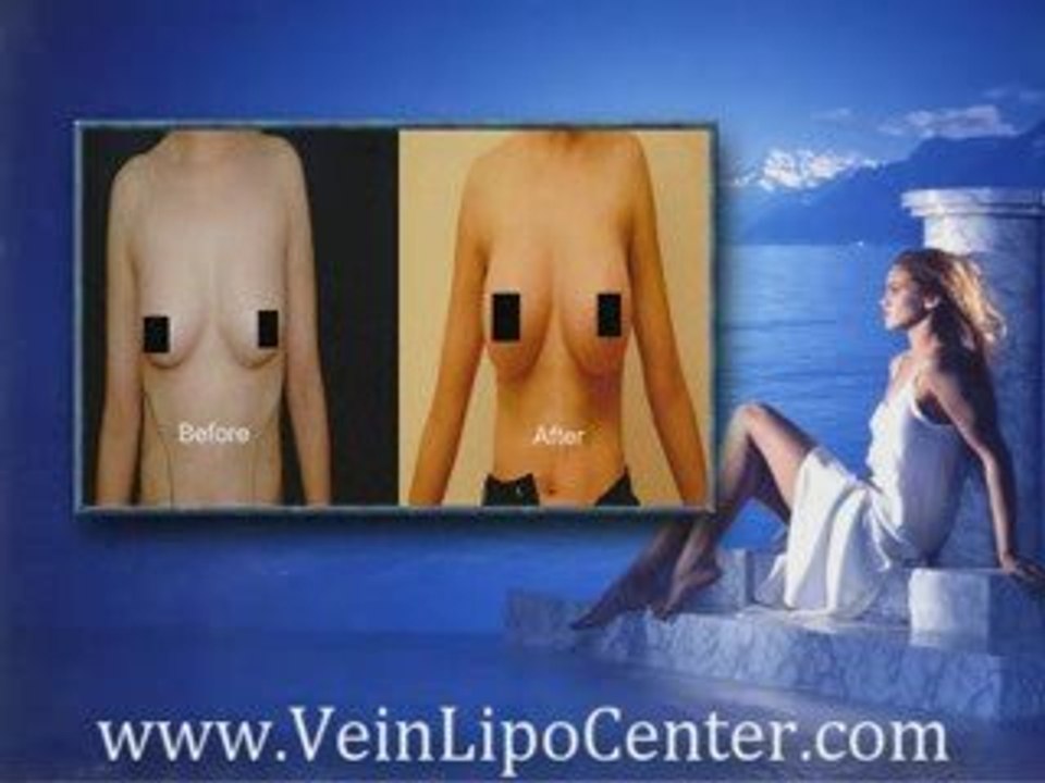 San Diego Breast Augmentation