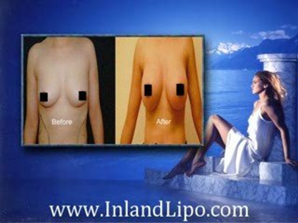 Temecula Breast Augmentation - Breast Augmentation Temecula