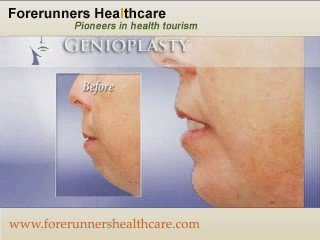 Low cost chin implant surgery in India for chin reconstructi