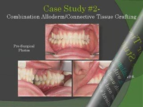 Michigan Periodontist Gum Grafting Procedures