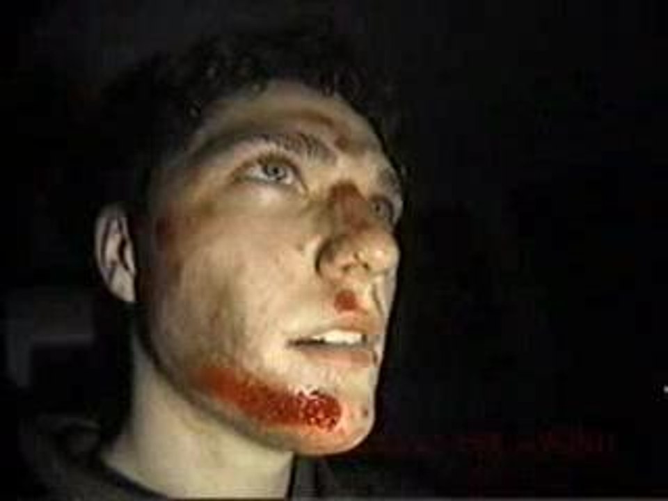 Bam Margera Skate Board Accident