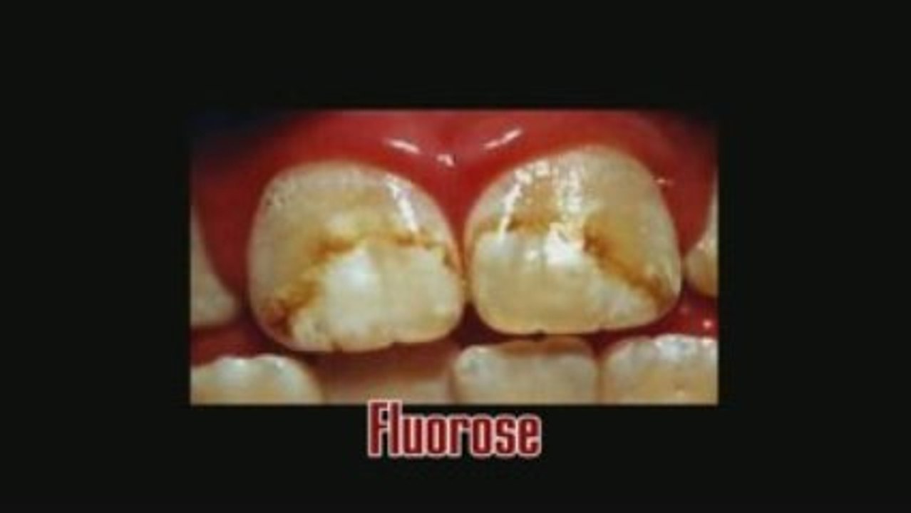 LLP - DANGER FLUOR