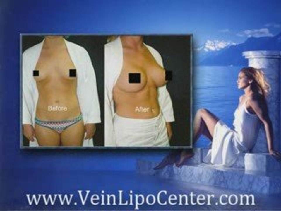 San Diego Breast Enlargement