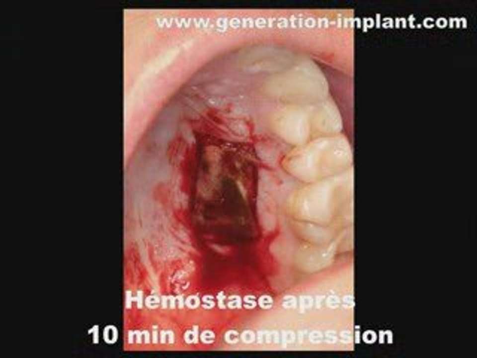 Implantlogie-Greffe gingivale libre