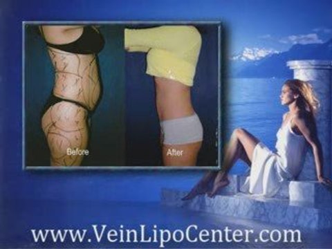 Lipo San Diego - San Diego Liposuction