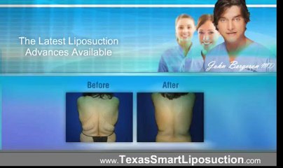 Lipo suction Houston