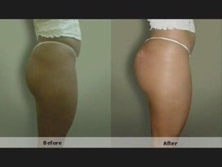Buttocks Injections, Amazing results in 1 hour