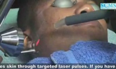 Laser Acne Removal