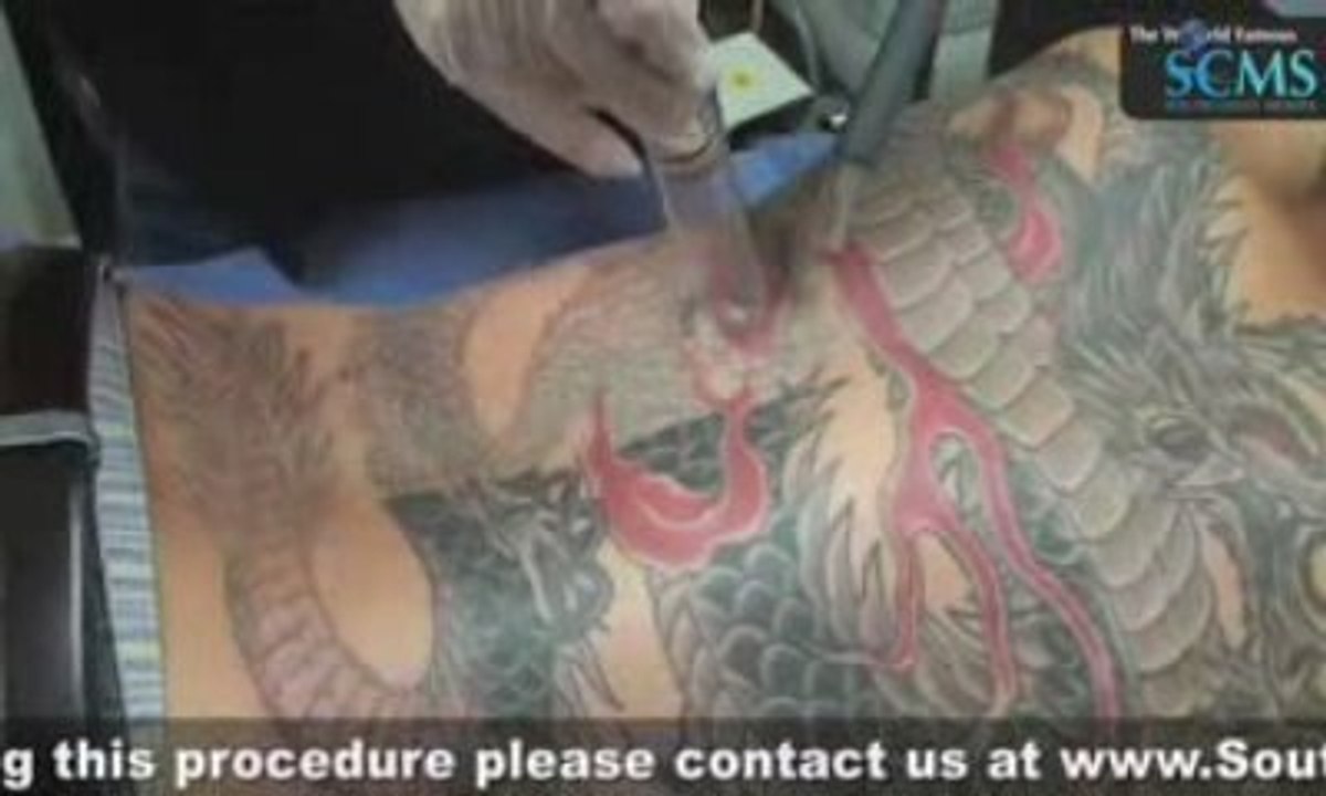 Laser Dragon Tattoo Removal