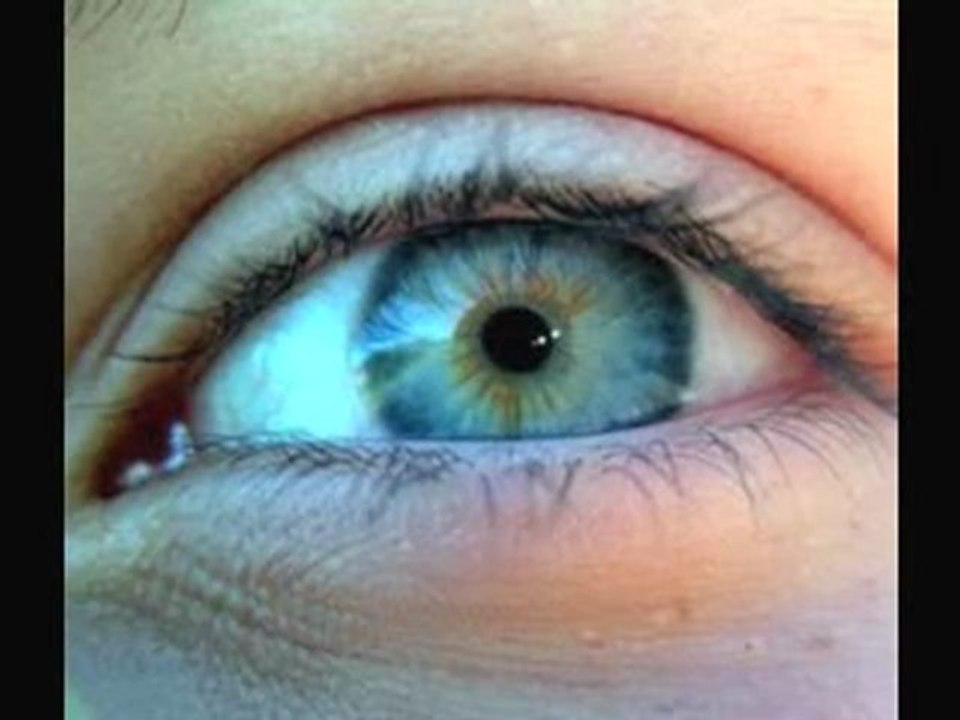 Lasik Eye Surgery - part 3