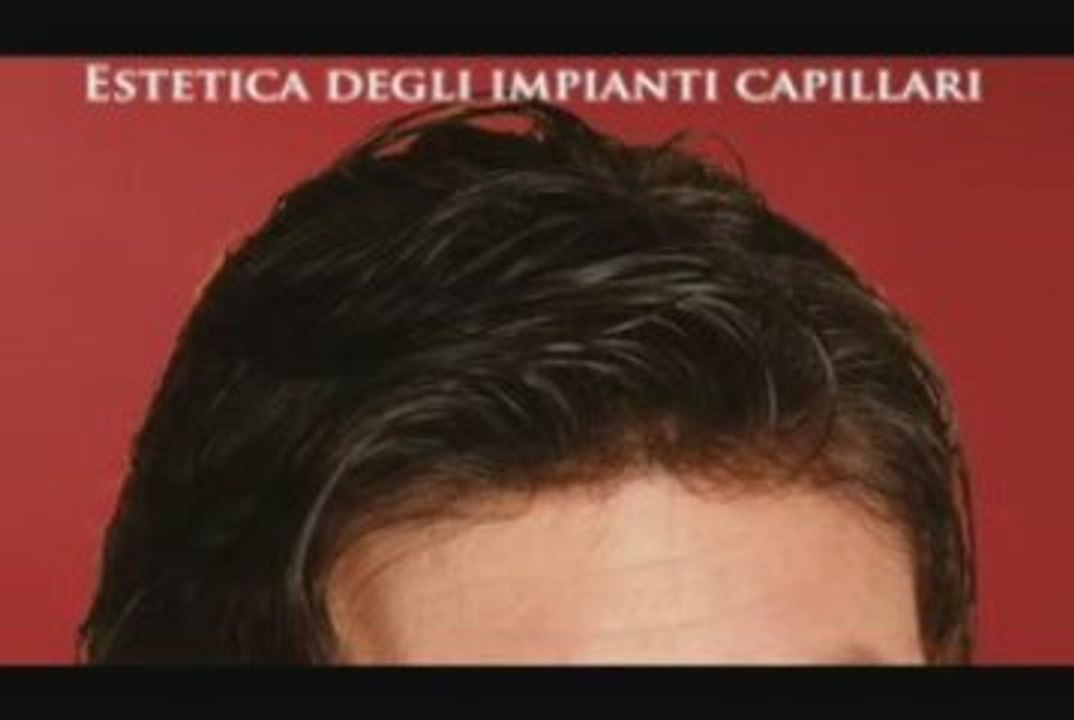 Protesi capillare, visita anche il sito www.luigiuomo.com