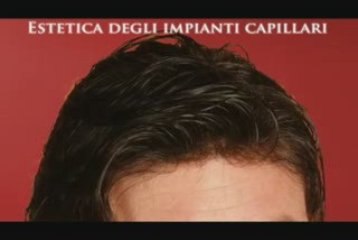 Protesi capillare, visita anche il sito www.luigiuomo.com