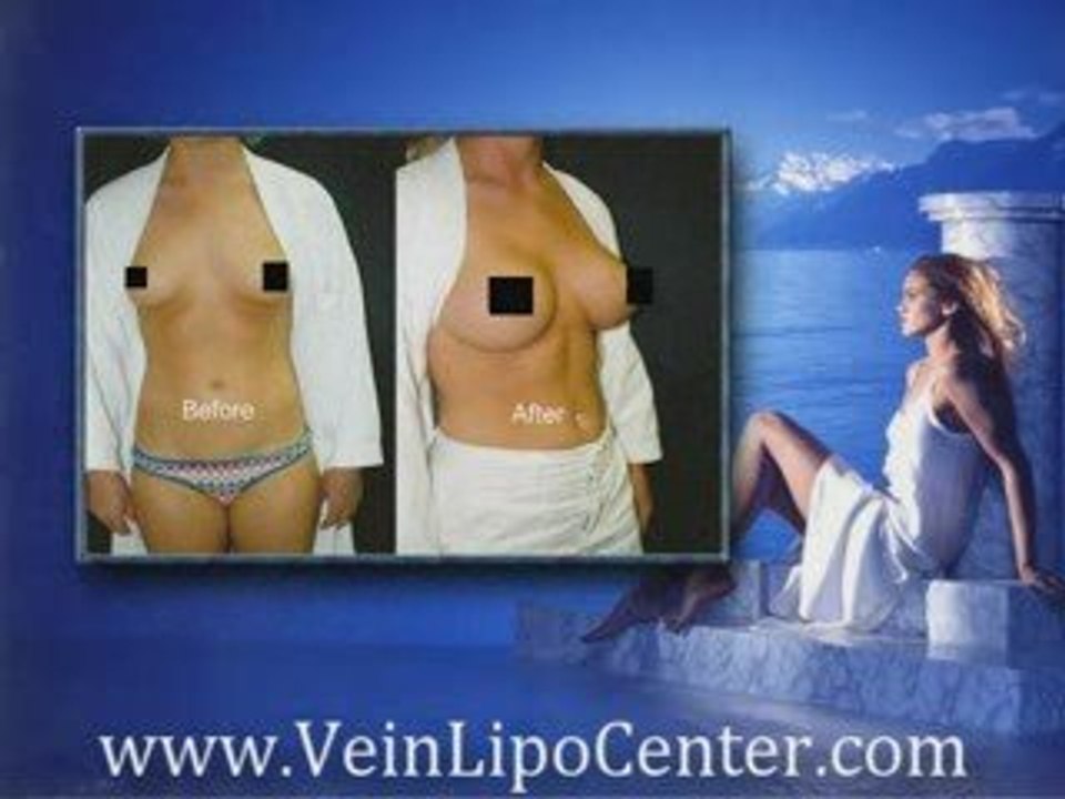 San Diego Breast Enlargement