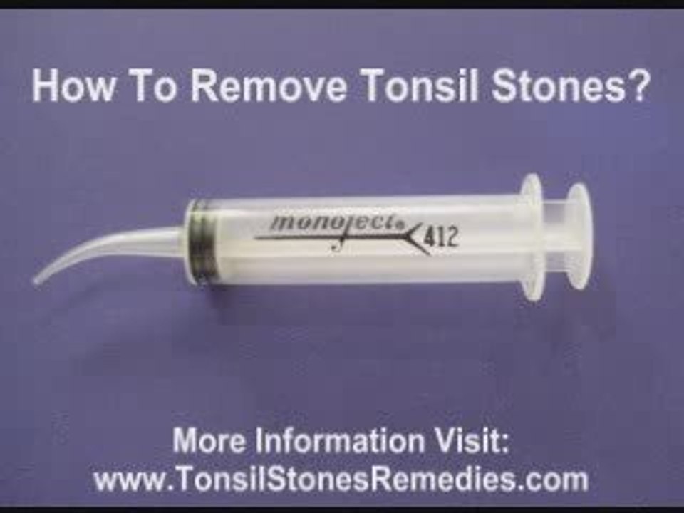 Preventing Tonsil Stones