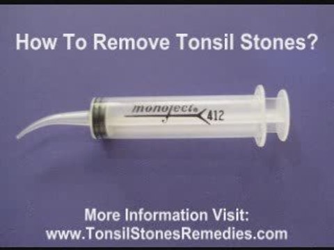 Tonsil Stones Removal