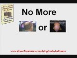 Male Baldness | Male Baldness cure | Male Baldness treatment