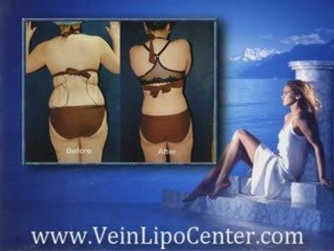 Liposuction San Diego - San Diego Liposuction