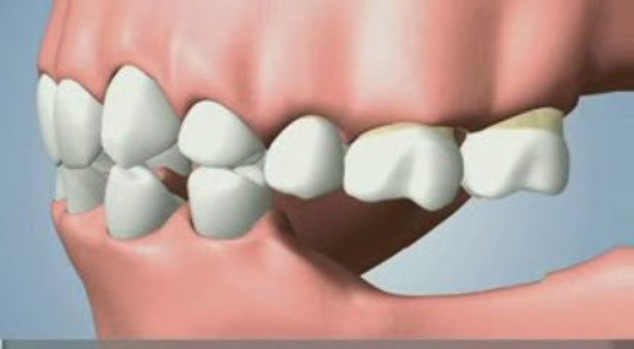 Reabsorcion de hueso post exodoncia